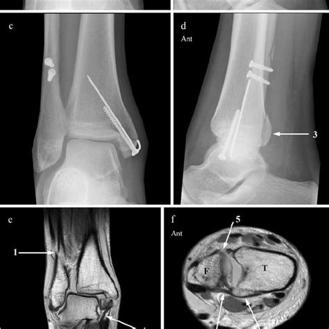Ap A And Lateral B Radiographs Show A Distal Fibula Fracture