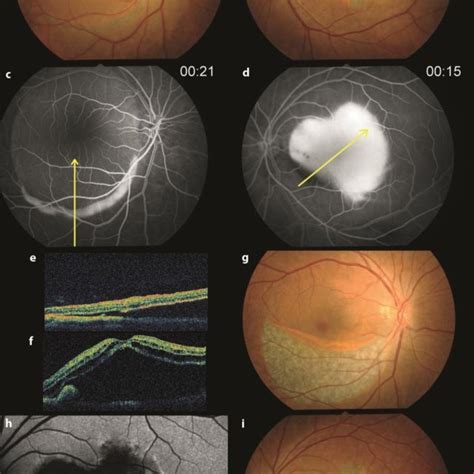 Case 3 A Fundus Photography Of The Right Eye Shows A 360° Rpe Tear B