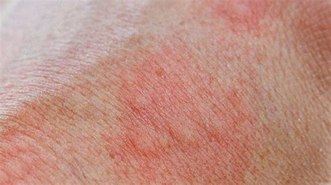 Top 10 Des Traitements Pour Les Allergies Boutons Et Cicatrices Top