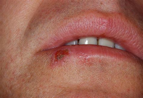 Ausnew Pharmacy Cold Sores Symptoms Causes Prevention And Treatment