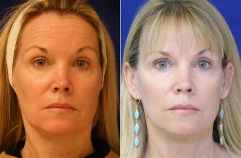 Is A Facelift Ideal After Major Weight Loss Imagup