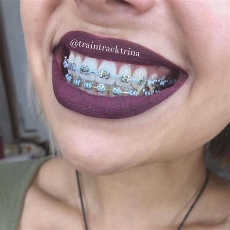 What Are The Cutest Colors For Braces Warehouse Of Ideas