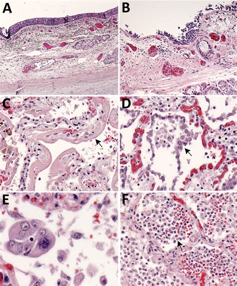 Figure Pathology And Pathogenesis Of Sars Cov Associated With Fatal Coronavirus Disease