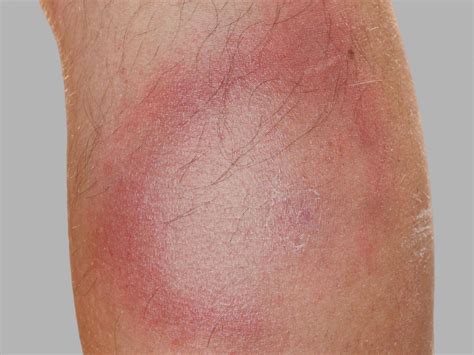 Lyme Disease Rash Symptoms Stages And Identification