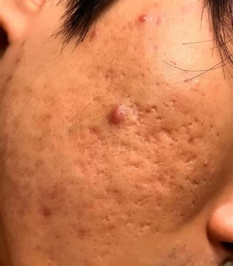 How Effective Is Intracel Rf For Deep Pitted Acne Scars Photo