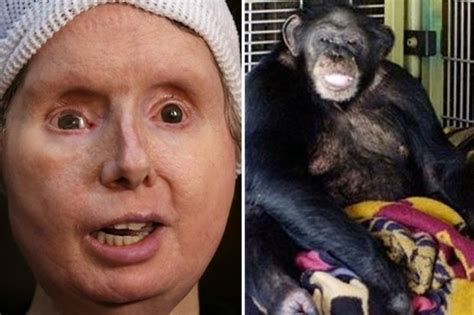 fresh setback for travis the chimp attack victim after her body rejects face transplant daily