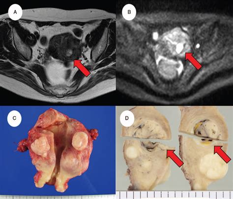 Uterine Tumor Resembling Ovarian Sex Cord Tumor Utrosct Wi Medicine