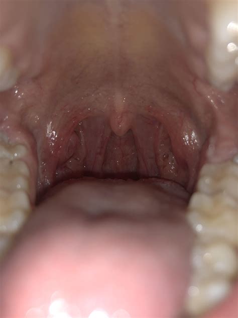 Does This Just Look Like Tonsil Stones More In Comments Diagnoseme