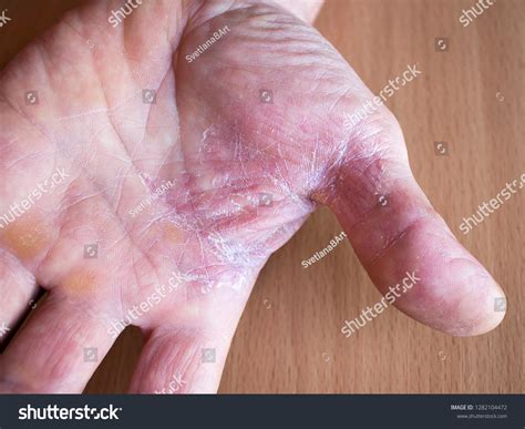 Peeling Dry Skin Hands Concept Treatment Stock Photo 1282104472
