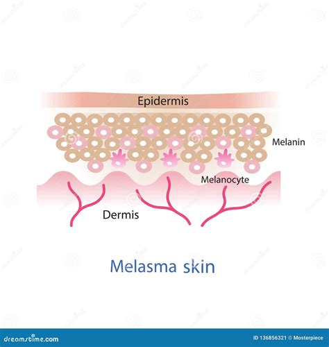 Melasma Skin Layer Stock Illustration Illustration Of Melanocyte
