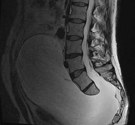 Mri T2 Weighted Sagittal View Showing A Large Anterior Sacral