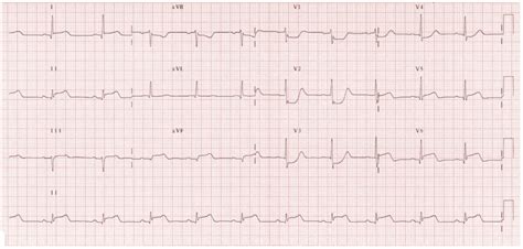 Five Ecg Patterns You Must Know Rebel Em Emergency Medicine Blog