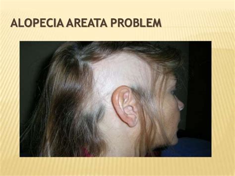 Reverse Traction Alopecia With Arganrain Regrow Your Hair Naturally