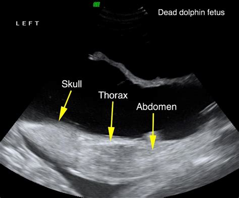 Y31 Dead Fetus Ultrasound Image Eurekalert Science News Releases