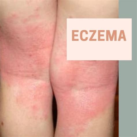 Eczema Treatment In Singapore Healthsprings