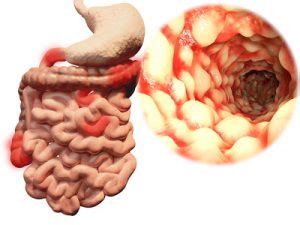 Bei uns brennt der kittel! Was ist Morbus Crohn? - Ursachen, Symptome, Behandlung ...