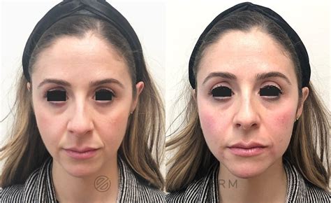 Dermal Fillers Before And After Photo Gallery Natick Ma Essential Dermatology