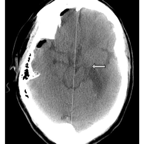 Ct Of The Head After Craniotomy And Evacuation Of Subdural Hematoma