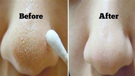 These could be painful red blemishes, whiteheads or blackheads that can be treated with skin care products to help keep the. Tips On How Easily To Get Rid Of Blackheads