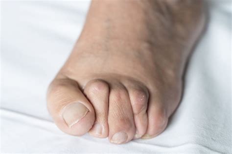 Hammer Mallet And Claw Toe Surgery Healthshare