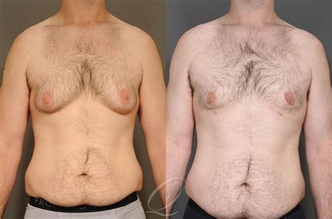 Male Breast Reduction Before After Photos Patient Serving