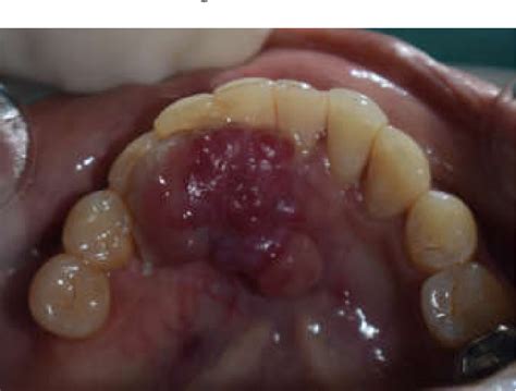 Figure From Lobular Capillary Hemangioma Pyogenic Granuloma With