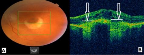 A Color Fundus Photograph Showing An Rpe Tear B Oct Open I
