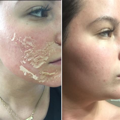 List 90 Pictures Chemical Peels Before And After Pictures Stunning