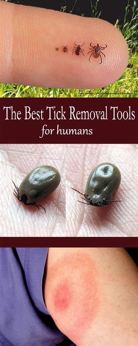 How To Remove A Tick From A Dog When The Head Is Embedded Howtomreov