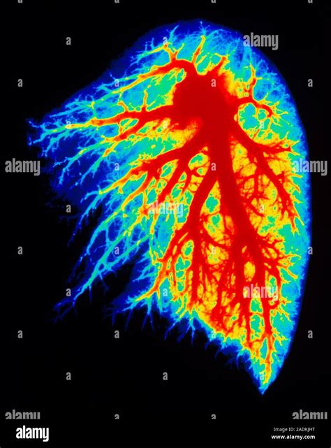 Pulmonary Arteries Coloured Angiogram X Ray Or Arteriogram Of The