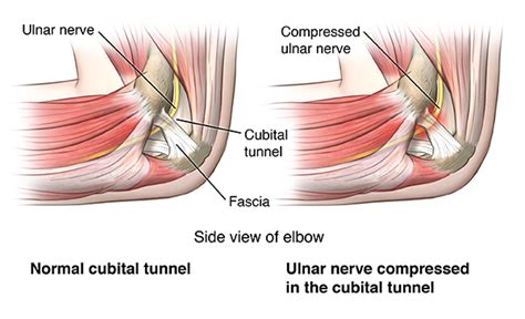 Cubital Tunnel Syndrome Health Encyclopedia University Of Rochester