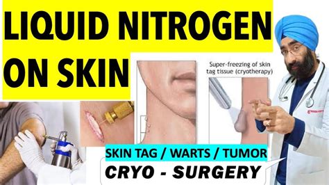 cryotherapy super freezing skin tags warts or tumor with liquid nitrogen cryosurgery youtube
