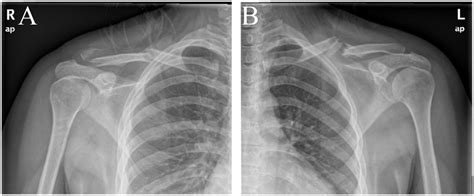 Preoperative Anteroposterior Radiographs Of The Bilateral Shoulder