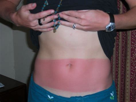 Upbeat News These Sunburn Fails Hurt Just To Look At