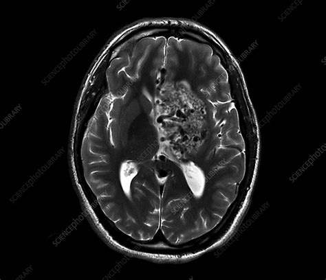 Subarachnoid Hemorrhage Mri Scan Stock Image C0551832 Science
