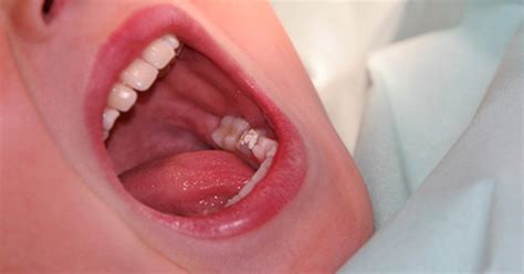 Mouth cancer can appear on the lips or anywhere in the mouth, including the tissues inside the cheeks, the tongue some signs of precancerous conditions may be indicators to see a doctor. Gum Cancer Symptoms | LIVESTRONG.COM