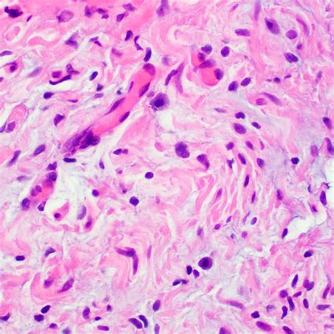 Pathology Outlines Plexiform Neurofibroma