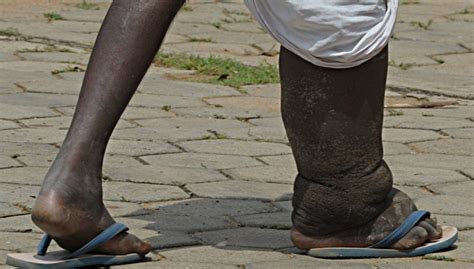 Elephantiasis Facts Symptoms Causes Treatment