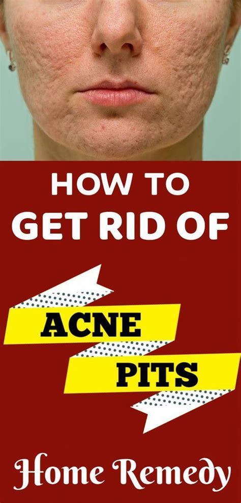 Acne Pits Home Remedy Dry Skin Routine Acne Dry Skin Care