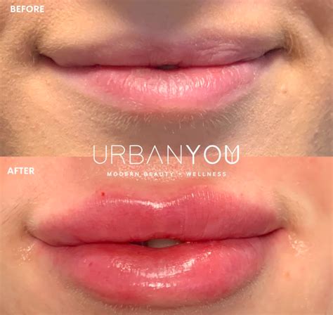 Russian Lip Filler Everything You Need To Know — Urban You Modern Beauty Wellness