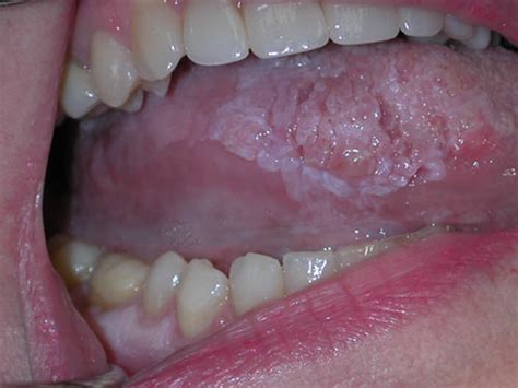 It's hard to cure oral cancer that has spread. PULSE GURU: Causes and Symptoms of Tongue Cancer