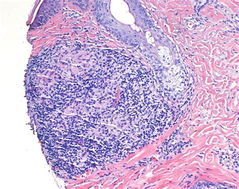 Virtual Grand Rounds In Dermatology 20 Granulomatous Rosacea