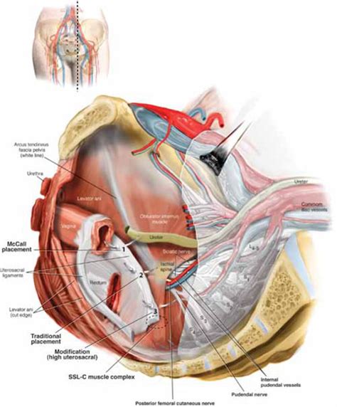 High Uterosacral Vaginal Vault Suspension To Repair Enterocele And