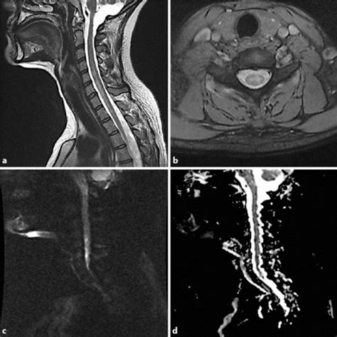 Mri Images Of The Cervical Spine A Axial Ti Weighted Image Of The Hot