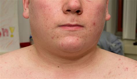 Face And Neck Swelling In A 16 Year Old Boy Bmj Case Reports