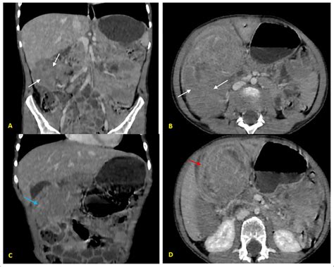 Injected Abdominal Ct Scan A B C D Showing An Asymmetric