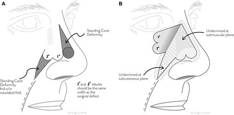 The Superiorly Based Bilobed Flap For Nasal Reconstruction Journal Of