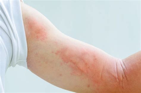 Rash On Arm Causes Itchy Red Treatments And Remedies American Celiac