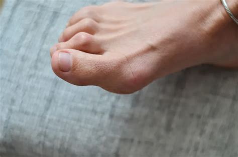 Bunions Symptoms Causes And Treatment Activebeat Your Daily Dose