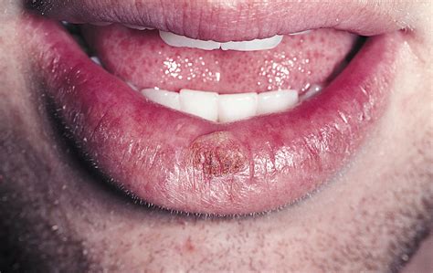 A Persistent Lower Lip Lesion Dermatology Jama Dermatology Jama